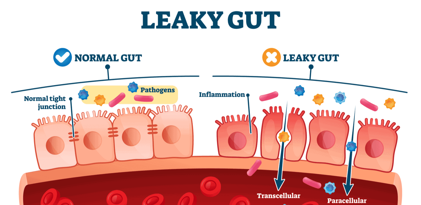 banner Lift Menselijk ras Lekkende darm (leaky gut): symptomen, testen, oorzaken & herstellen